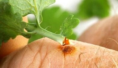How to get a wart with celandin