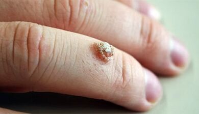 Methods to treat warts with celandin