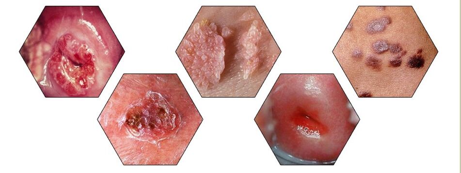 dangerous types of papillomas