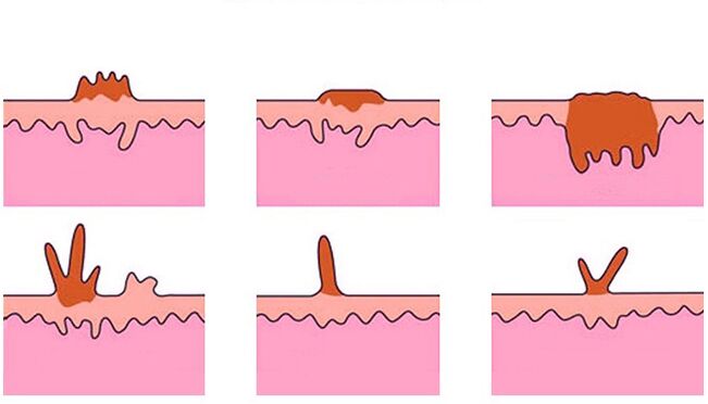 types of papillomas on the body