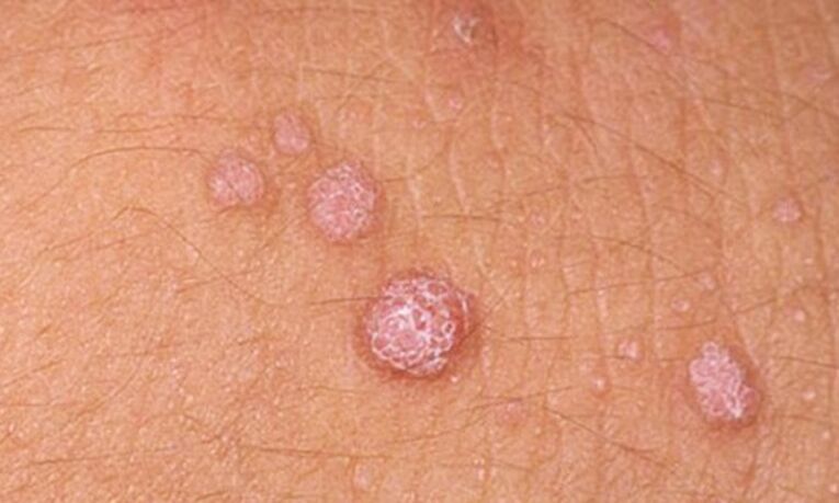 HPV causes the appearance of skin papillomas