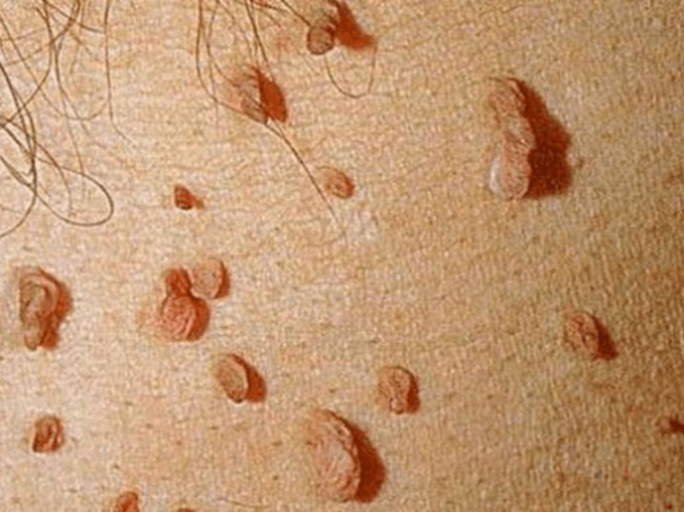Papillomas on the body
