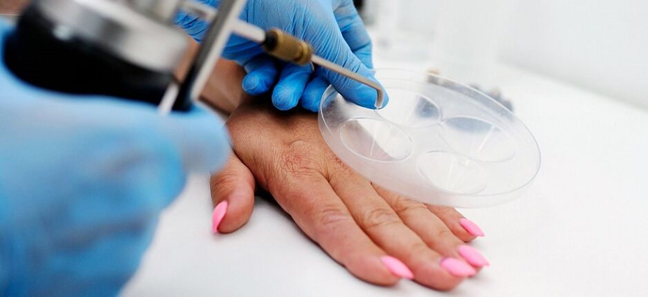 professional wart removal at your fingertips