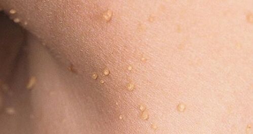 How does the human papillomavirus manifest