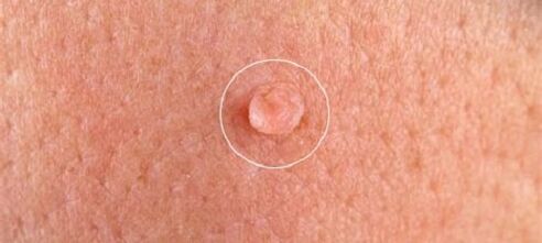 genital warts on the body