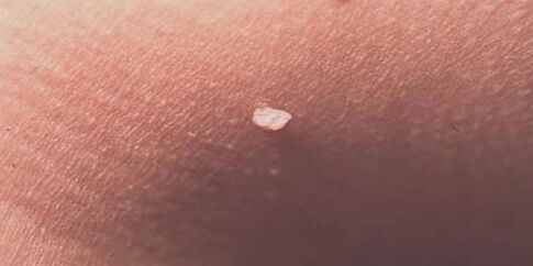 human papilloma virus on the skin