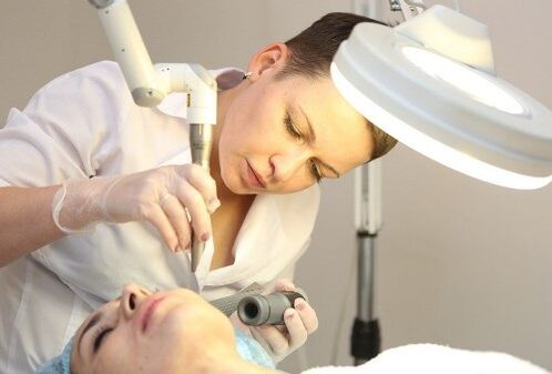 laser removal of human papilloma virus