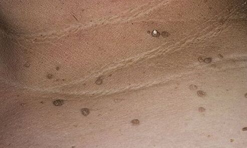 manifestations of human papilloma virus