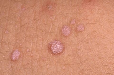 symptoms of human papilloma virus
