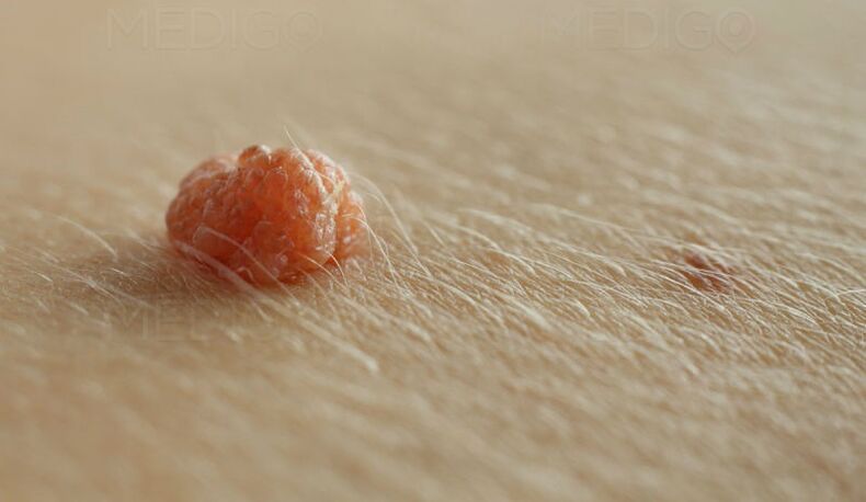 papilloma on the skin
