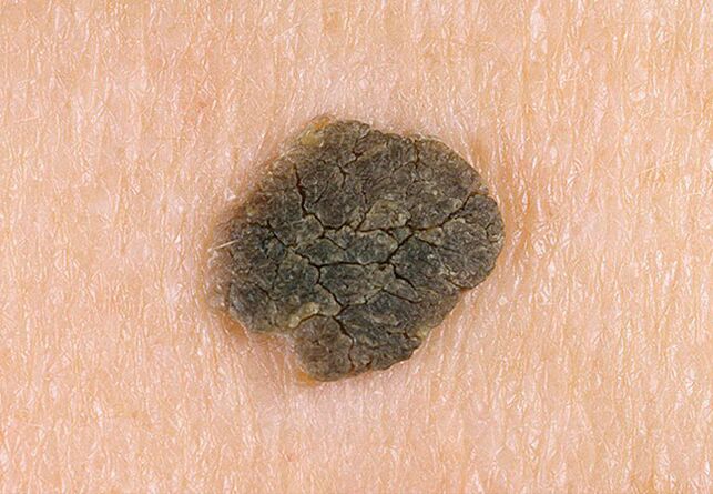 black wart on skin