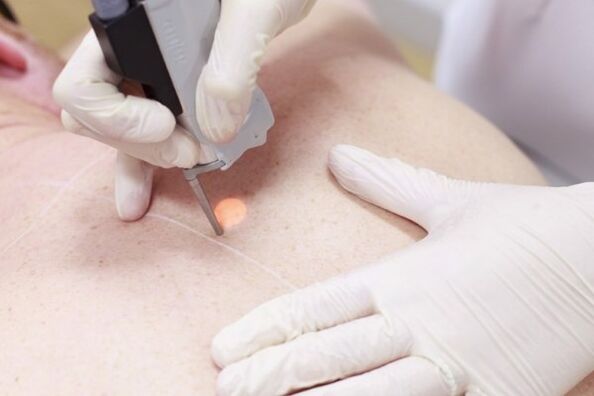 A popular method for removing papillomas with a laser