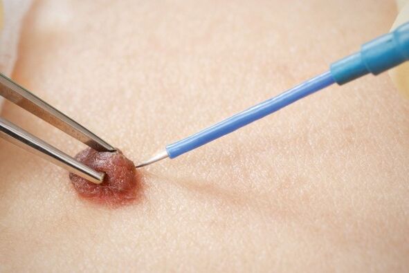 Papilloma electrocautery