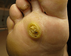 Subith Papillomas