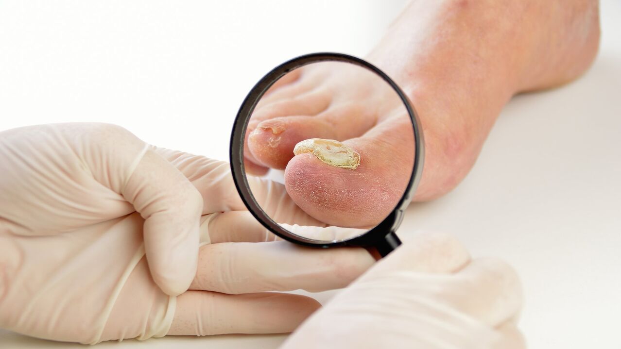 treatment of nail fungus with Keramin cream